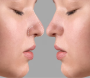 Blog Rhinoplasty