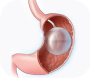 Gastric Baloon