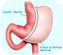 Gastric Sleeve