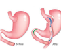 Gastric Bypass