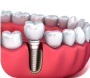 Implant Treatment