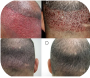 FUE Hair Transplant