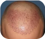 DHI Hair Transplant