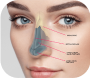 Rhinoplasty