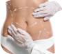 Abdominoplasty