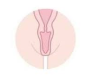 Labiaplasty